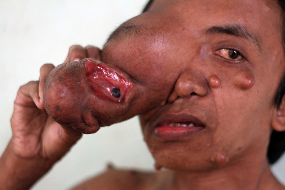 Herdi Firmansyah z Indonésie bojuje s obřím nádorem.