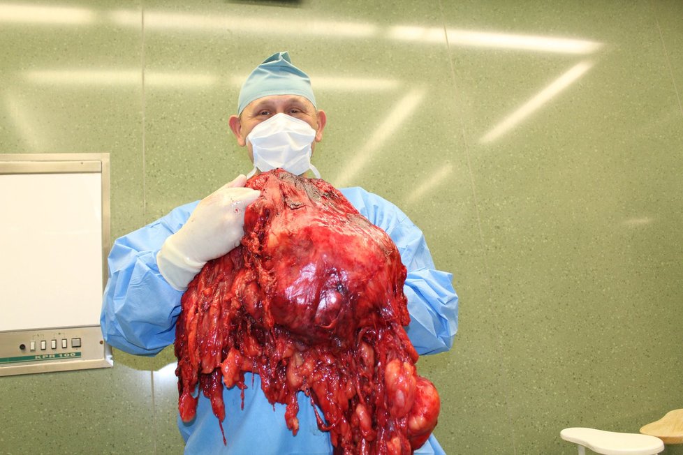 Lékaři zlínské krajské nemocnice vyoperovali dvěma mužům nádory vážící 27 (na archivním snímku) a 12 kilogramů. U obou mužů ve věku 68 a 40 let šlo o zhoubné tumory. Nádor vážící 27 kilogramů muži tlačil na ledviny, játra, plíce.