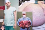 Sedmačtyřicetileté pacientce vyoperovali lékaři ve Zlíně nádor o váze 36 kilogramů.