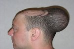 Muži byl do hlavy vložen implantát, který mu měl roztáhnout kůži porostlou vlasy, aby mu mohla nahradit tu část na temeni.