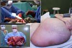 Sedmačtyřicetileté pacientce vyoperovali lékaři ve Zlíně nádor o váze 36 kilogramů.