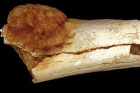 Rakovina zabíjela lidi už v pravěku: Vědci objevili zhoubný nádor starý 1,7 milionu let!