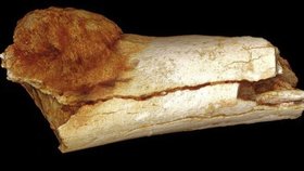 Nádor na prstu pravěkého člověka starého asi 1,7 milionu let