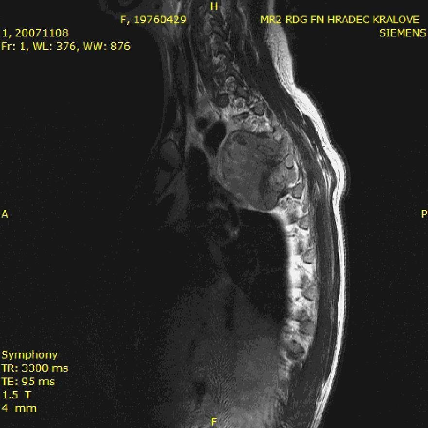 Nádor rostl na páteři.
