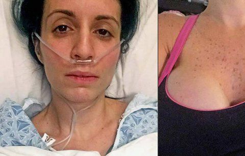 Žena si nechala udělat piercing v bradavce: Přišla kvůli němu o prso