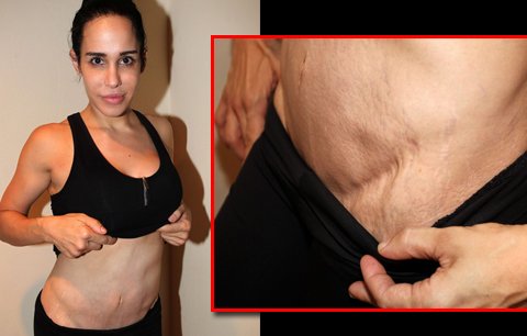 Oktomáma Nadya Suleman (36) ukázala jizvy: Cena za osmerčata