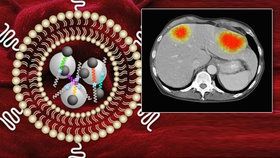 S léčbou rakoviny mají pomoci nanosenzory. Ukáží, jak se daří ničit nádory
