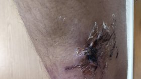 Děsivý pohled na nohu napadeného muže z Rousínova. Pes mu způsobil vážná poranění.