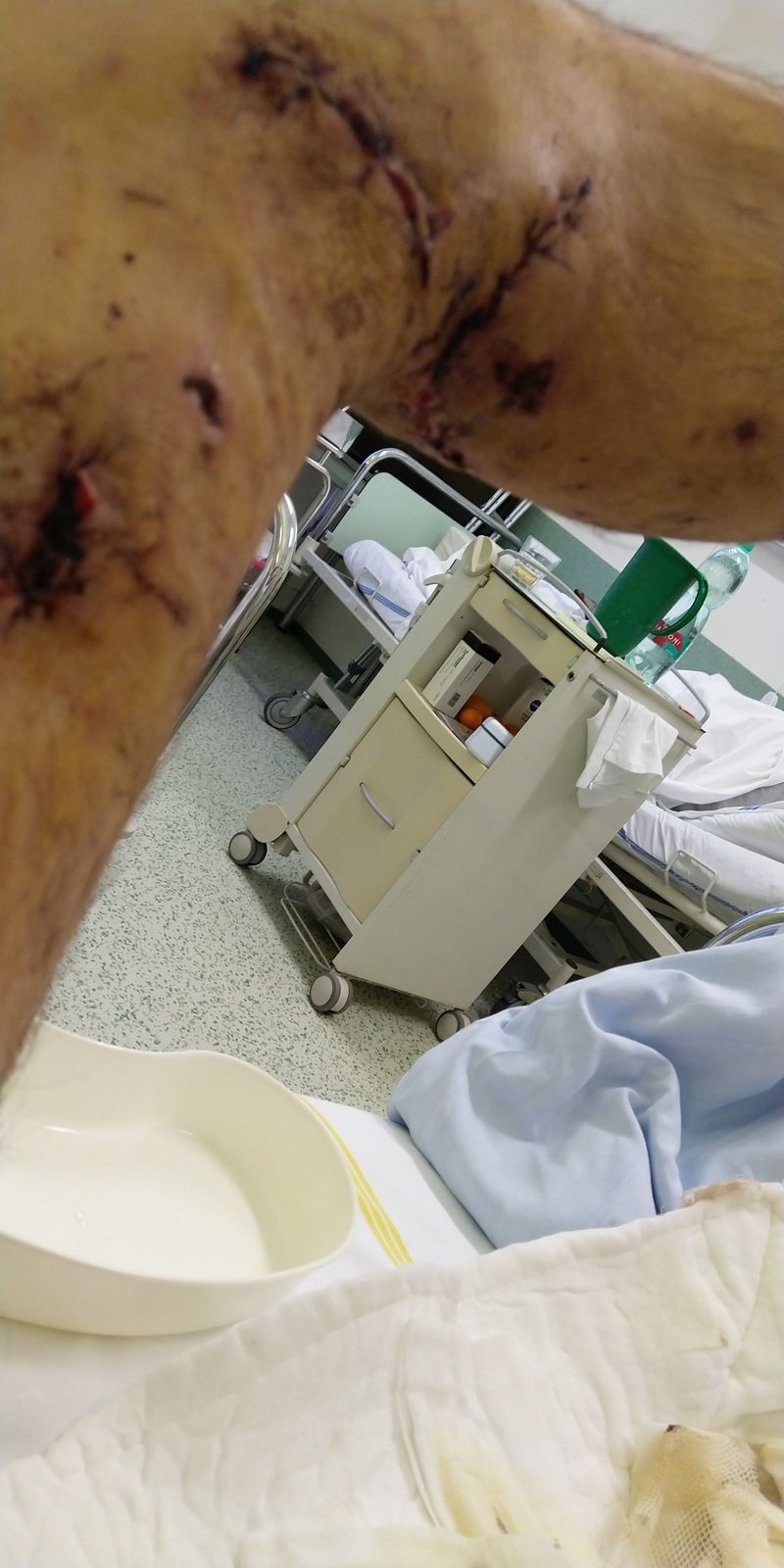 Napadený muž z Rousínova ve vyškovské nemocnici.