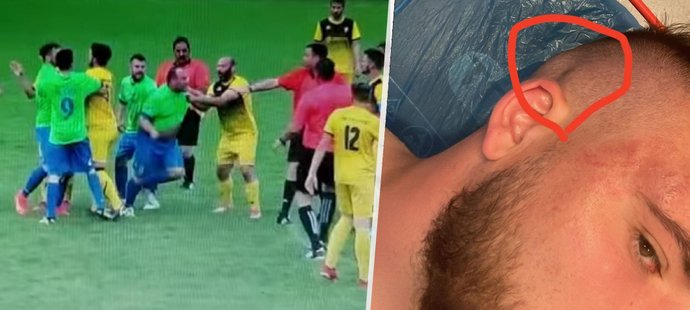 Napadený fotbalista byl po útoku běsnícího protihráče zraněn