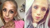 Zemřela dlouholetá bojovnice s anorexií Natálie: Ve 23 letech vážila pouhých 20 kilo