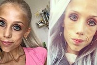 Zemřela dlouholetá bojovnice s anorexií Natálie: Ve 23 letech vážila pouhých 20 kilo