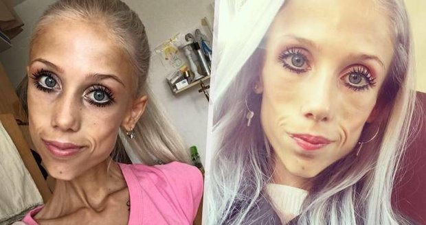 Zemřela dlouholetá bojovnice s anorexií Natálie: Ve 23 letech vážila pouhých 20 kilo