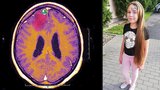 Natálka (12) upadala do bezvědomí: Děti s epilepsií trpí během pandemie osaměním