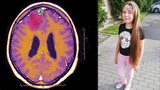 Natálka (12) upadala do bezvědomí: Děti s epilepsií trpí během pandemie osaměním