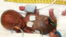 Při narození byl chlapec jako pírko, jeho kůže byla jemná jako pergamen. Vážil pouhých 275 gramů a měřil 27 centimetrů.