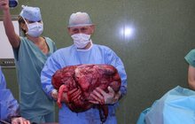 Žena ze Zlínska: V těle měla 36 kg nádor! 