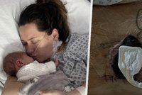 Novopečená maminka (27) krátce po porodu málem zemřela. Z vyrážky na břiše se vyklubal masožravý virus!