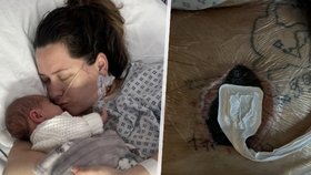 Novopečená maminka (27) krátce po porodu málem zemřela. Z vyrážky na břiše se vyklubal masožravý virus! 