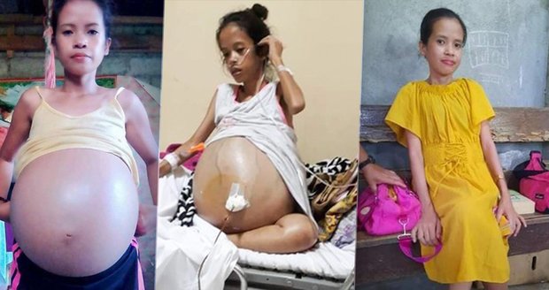 Žena (28) si myslela, že je těhotná: V těle má šest nádorů vážících 90kg!