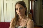 Američanka trpí zvláštní genetickou poruchou, při níž je její tělo doslova poseto nádory