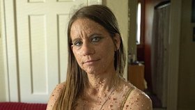 Američanka trpí zvláštní genetickou poruchou, při níž je její tělo doslova poseto nádory