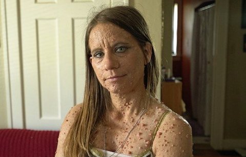 Nemoc, která jí ničí život: Američanka má na těle šest tisíc nádorů!
