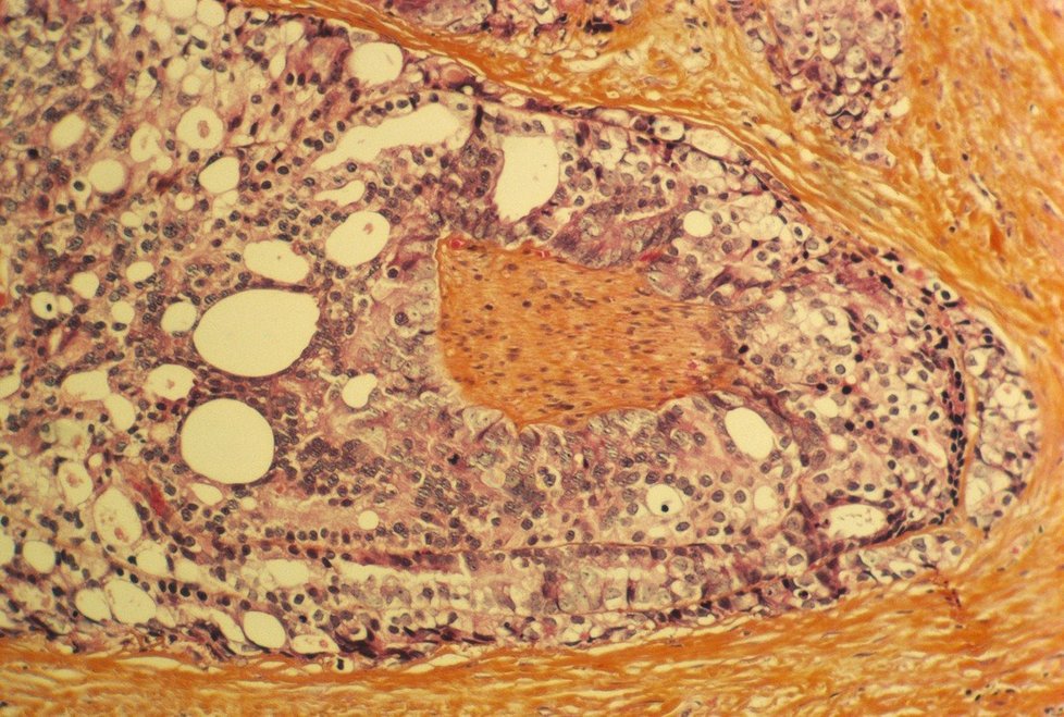 Detail rakoviny prostaty