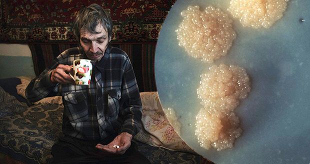 V Česku zabíjí tuberkulóza. Šíří ji i Ukrajinci a bezdomovci, problém mají kuřáci