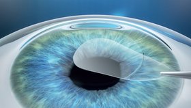 Oční chirurg odstraní přebytečnou rohovkovou tkáň pomocí speciální pinzety.
