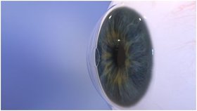 Hydrogelový implantát Raindrop o průměru 2 mm vloží oční chirurg do rohovky.