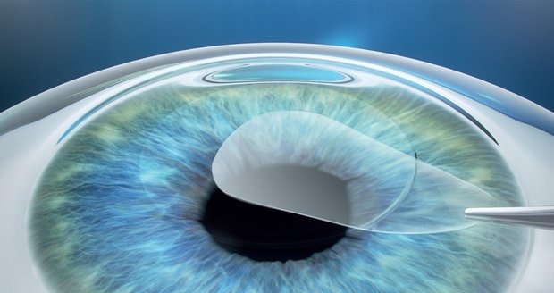 Oční chirurg pomocí pinzety šetrně odstraní přebytečnou tkáň.