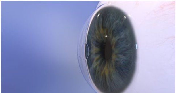Hydrogelový implantát Raindrop o průměru 2 mm vloží oční chirurg do rohovky.