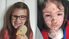 Matka zveřejnila dech beroucí fotky své dcery. Tohle jsou nejhorší neštovice, které svět viděl!