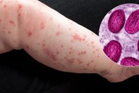 V Česku po pauze znovu řádí neštovice: Lékaři řekli, co za tím je