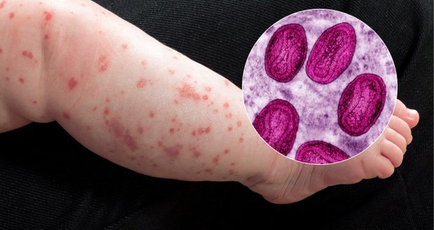 V Česku po pauze znovu řádí neštovice: Lékaři řekli, co za tím je