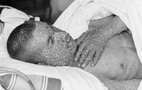 Oteplování na Sibiři odkrývá nebezpečné hroby: Hrozí světu epidemie neštovic?