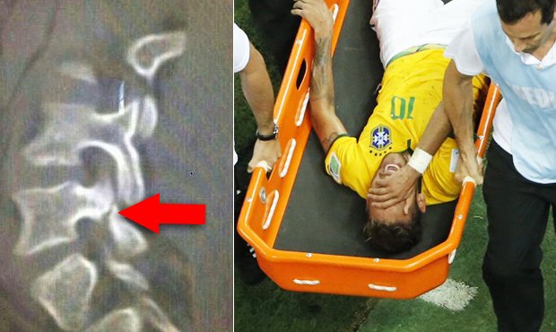 Brazílie plakala! Neymar měl zlomený obratel, na MS si v semifinále už nezahrál