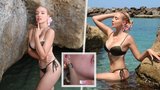 Nicole Šáchovou na dovolené trápí komplikace. Musí se vyhýbat slunci