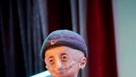 Indický chlapec trpěl vzácnou progerií. Nihal zemřel ve věku 15 let.