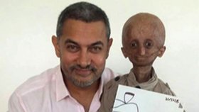 Indický chlapec trpěl vzácnou progerií. Nihal zemřel ve věku 15 let.