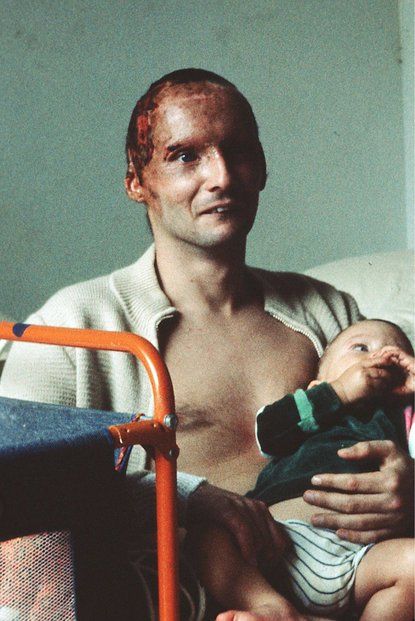 Pyšný táta Niki Lauda krátce poté, co přežil šílenou nehodu, při které utrpěl rozsáhlé popáleniny