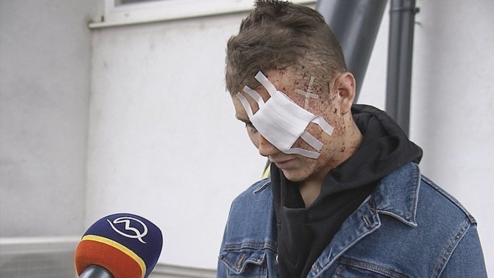 Andreas (17) měl štěstí v neštěstí. Havárii autobusu smrti přežil. Utrpěl však tržnou ránu nad okem.