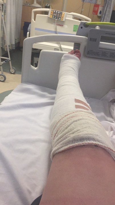 Ošklivá čtyřnásobná zlomenina nohy potkala Lulu na její rozlučce se svobodou. Skončila v nemocnici.