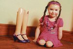 Jako dvouletá přišla kvůli nemoci o ruku a obě nohy