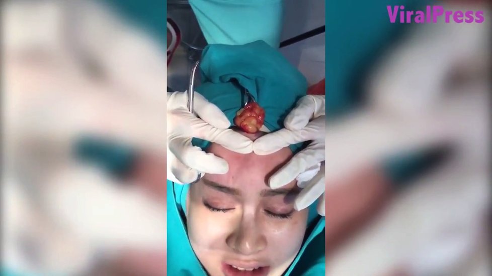 Nong Guang (41) se zanítilo čelo po plastickém zákroku. Lékař z něj vymačkal velké množství hnisu.