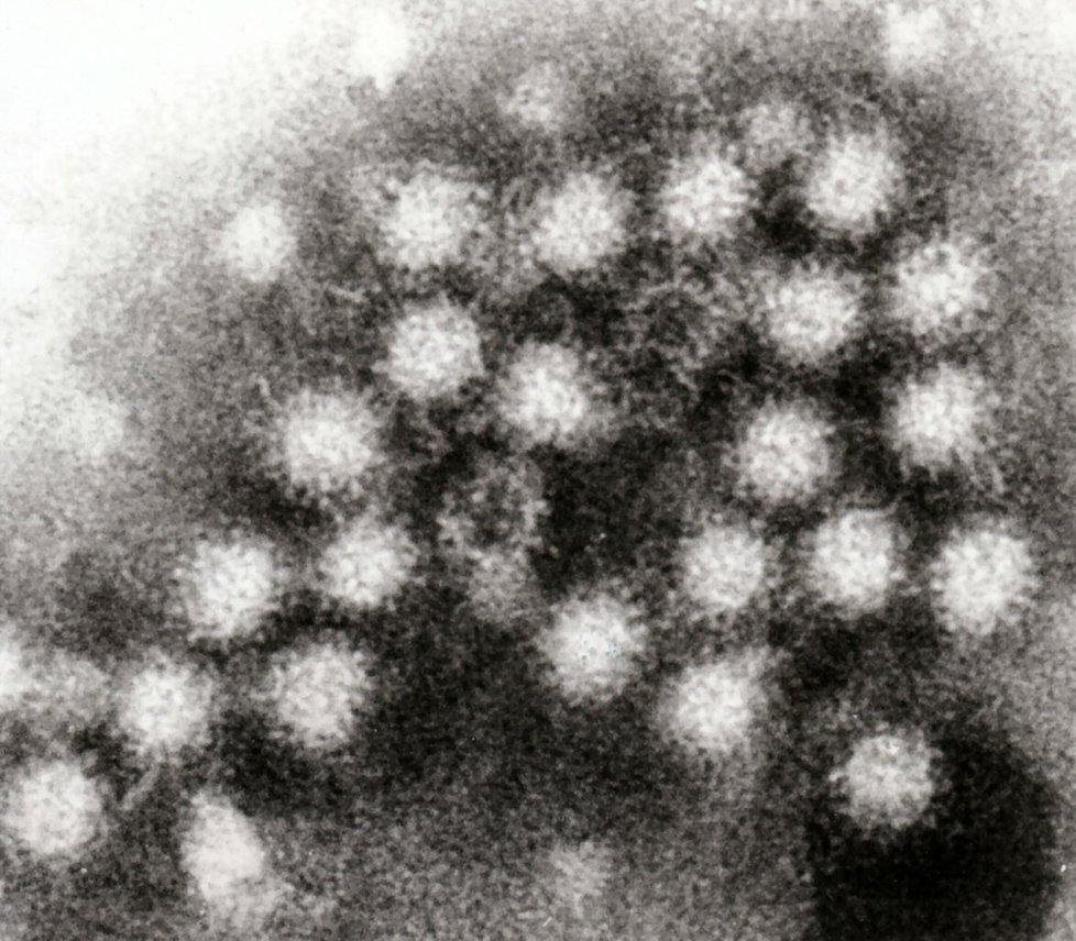 Norovirus.