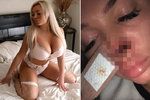 Instagramová modelka se rozešla se svým přítelem. Ukousl jí za to nos!
