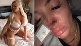 Instagramová modelka se rozešla s přítelem. Ukousl jí za to nos!