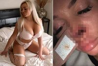 Instagramová modelka se rozešla s přítelem. Ukousl jí za to nos!